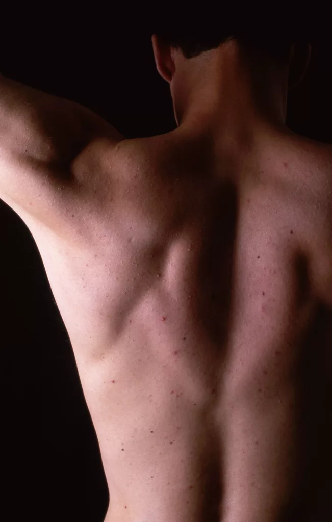 Le secret pour un bouton d’acné parfait ! (Photo Clémence Poquet)