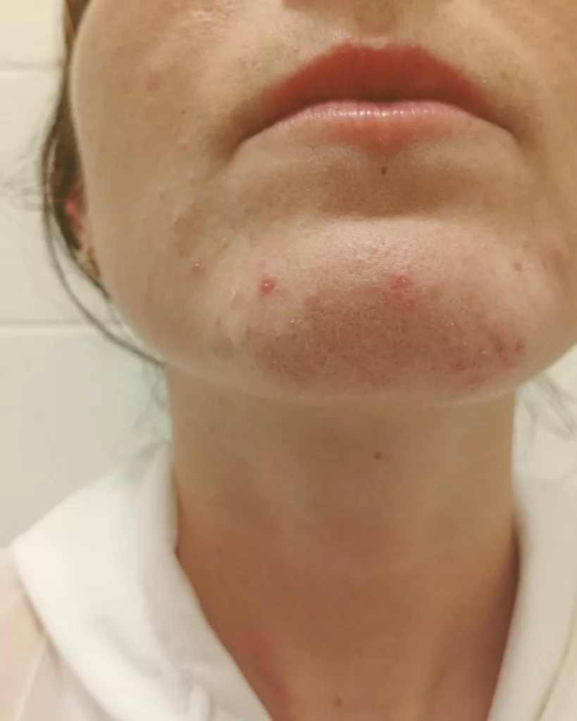 Peau à tendance acnéique : 3 mois de cure pour initier un nouvel équilibre