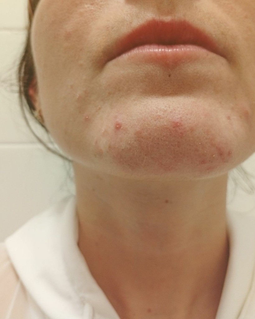 Peau à tendance acnéique : 3 mois de cure pour initier un nouvel équilibre