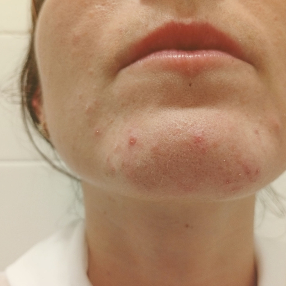 Peau à tendance acnéique : 3 mois de cure pour initier un nouvel équilibre Peau à tendance acnéique : 3 mois de cure pour initier un nouvel équilibre